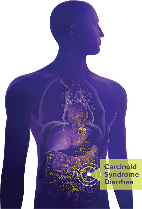 Carcinoid Syndrome Diarrhea